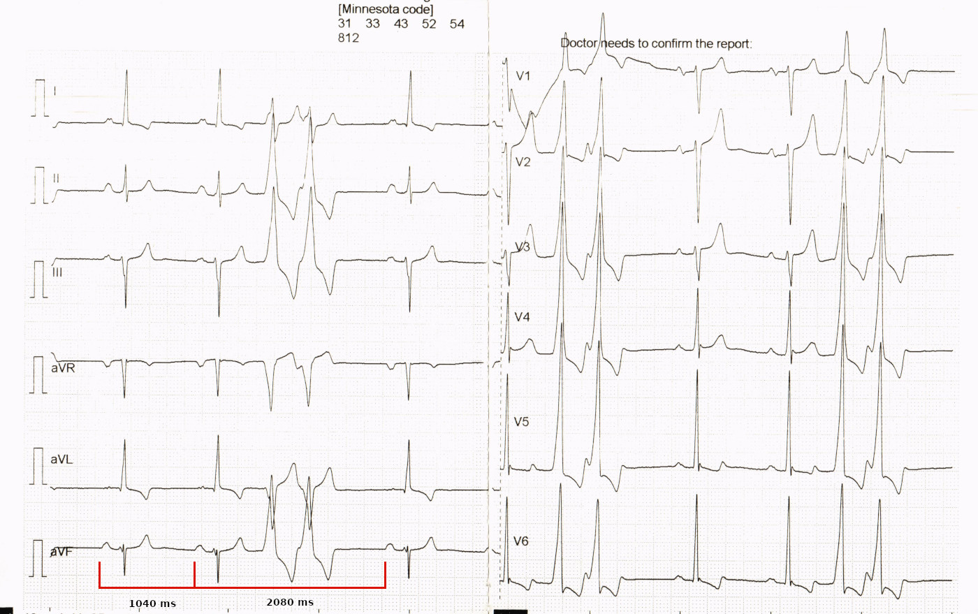 thangavel ecg sca004_m.jpg